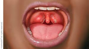 Image result for Tonsillitis