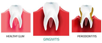 What is the best home remedy for gum disease? Gingivitis Treatment How To Reverse And Get Rid Of Gingivitis