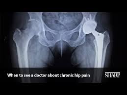 What are the types of bone cancer? When To See A Doctor About Chronic Hip Pain Youtube