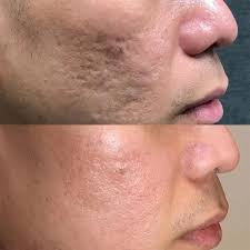 Acne and Acne Scar Treatment
