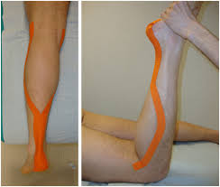 Image result for Taping for Soleus and Achilles