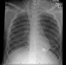 Image result for Air Bronchogram