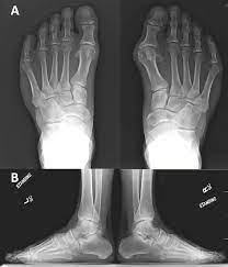 Tophaceous gout is a severe form of gout in which masses called tophi form around the joints and doctors diagnose tophaceous gout by taking a small sample from a suspected tophi and checking it. Cureus A Case Of A Second Intermetatarsal Space Gouty Tophus With A Presentation Similar To A Morton S Neuroma