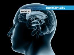 Information About Surgery For Ventriculoperitoneal Shunt Vp Shunt Dr David Oehme Melbourne Neurosurgeon