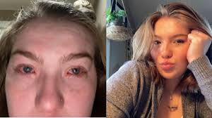 LANGKA! Wanita Ini Alami Alergi setelah Bertemu Pacar, Wajah dan Mata Gatal  Berair 'Ada Sesuatu'