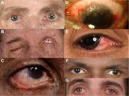 Xeroderma pigmentosum is a rare genetic disorder that affects the skin, the eyes, and sometimes the nervous system. Ophthalmic Manifestations Of Xeroderma Pigmentosum Ophthalmology