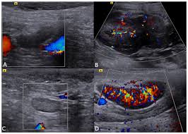 Lymph nodes are part of the lymphatic system, which helps to protect us from infection and disease. Ultrasonography For Lymph Nodes Metastasis Identification In Bitches With Mammary Neoplasms Scientific Reports