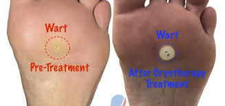 Causes of warts on your feet. Podiatrist Treatment For Foot Warts Or Plantar Verrucae