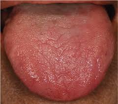 Image result for lichen planus on tongue)