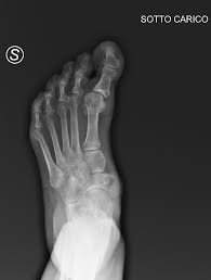 Image result for Hallux Varus