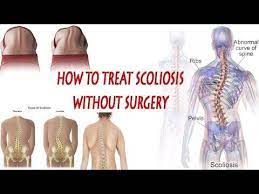 How To Treat Scoliosis Scoliosis Exercises At Home How To Treat Scoliosis Without Surgery Youtube Scoliosis Scoliosis Exercises Scoliosis Treatment