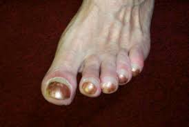 Image result for Clubbing nails feet