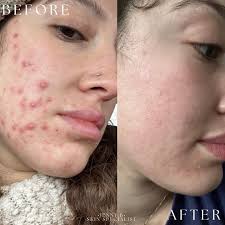 My first day back couldn't have been better. Hard to leave my babies but  you all made my day amazing! #vlog #asmr #esthetician #acne #clearskin  #oklahoma #okc @acnespecialistokc @fitspaokc