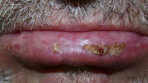 The strongest risk factor for developing skin cancer is ultraviolet (uv) ray exposure, typically from the sun. Skin Cancer Rash Itchiness And Symptoms