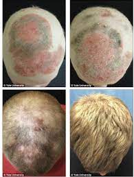 Experts previously assumed that in the case of complete baldness, follicles are completely absent from the scalp, so they cannot be. Treating Alopecia Universalis With Xeljanz May Have Serious Side Effects
