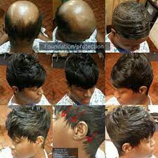 Quickweave Protective Style Due To Alopecia Hair Styles Alopecia Hairstyles Black Women Hair Loss