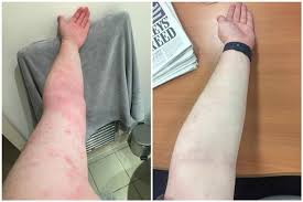 Epsom salt bath is a popular eczema treatment. Review My Eczema Went From This To This Using Salt Liverpool Echo