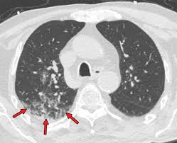 When i was first diagnosed, they would drag their feet and get to it when they felt like it. Chest Ct In Covid 19 What The Radiologist Needs To Know Radiographics