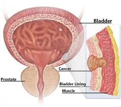 It's possible for bladder cancer symptoms and signs in females to be somewhat different than in males. Muscle Invasive Bladder Cancer Mibc Diagnosis And Treatment