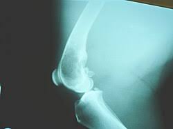 Image result for Osteosarcoma