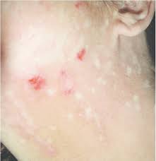 Image result for Postinflammatory Hypopigmentation