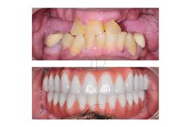 Image result for Gingivitis