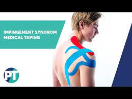 Medical Taping Bei Einem Impingement Syndrom Der Schulter Physiotape