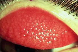 Image result for Allergic Conjunctivitis