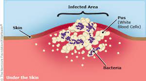 This type of bacteria is resistant to many different antibiotics. Mrsa For Teens Nemours Kidshealth