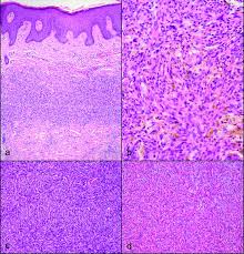 Malignant tumours and benign tumours: Dermatopathology 101 Part 2 Skin Tumors Liersch 2017 Jddg Journal Der Deutschen Dermatologischen Gesellschaft Wiley Online Library