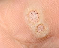 Image result for genital warts