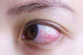 We did not find results for: Keratitis Lifepack Id