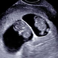 Overall, the accuracy of sonographic dating in the first trimester is ~5 days (95% confidence range). First Baby Scan Dating Scan Viability Scan London