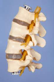 Spinalkanalstenose Und Foraminalstenose Nerven Und Ruckenmarks Einengung Www Gelenk Doktor De