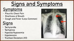Image result for Pneumothorax