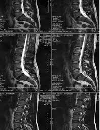 Spondylolisthesis Wirbelgleiten L5 Gegenuber S1 Bandscheibenvorfall De