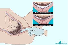 Membrane Sweep When And How Is It Done
