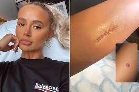 Some types of skin cancer are more dangerous than others, but if you have a spot. Molly Mae Hague Has Leg Mole Removed Amid Fears It Could Become Cancerous Mirror Online