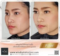juicy lips filler เพ ยง 1 cc ก สามารถปร บร ปหน าให สวยหวานข นได จากการปร บร มฝ ปากให สวย ฉ ำวาว ด juicy ด วยเทคน คเฉพาะของ wind holistic clinic เทคน ค