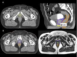 What is a ct scan? Estro Acrop Consensus Guideline On Ct And Mri Based Target Volume Delineation For Primary Radiation Therapy Of Localized Prostate Cancer Radiotherapy And Oncology