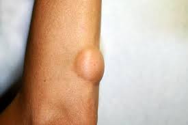 They develop when cells grow uncontrollably. Tumors Benign Premalignant And Malignant