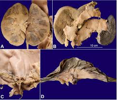 Scielo Brasil Alk Anaplastic Large Cell Lymphoma With Extensive Cardiac Involvement A Rare Case Report And Review Of The Literature Alk Anaplastic Large Cell Lymphoma With Extensive Cardiac Involvement A