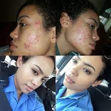 Some of my patients do develop acne a few months after stopping birth control. Does Birth Control Help Clear Up Acne Beautylish