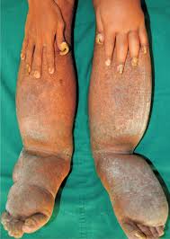 Image result for Yellow nail syndrome feet