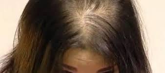 أناقة مغربية افضل وصفة للتخلص من الصلع الامامي و علاج الشعر الخفيف و منع تساقط الشعر Best Hair Transplant Light Hair Hair Transplant