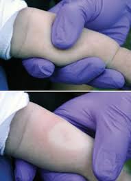 Image result for Capillary Refill