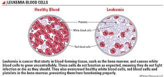 Myelodysplastic syndrome (mds) | between the normal and the acute leukemia. Patient Resource Publishing Leukemias