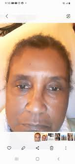 My port was removed today I'm in soooo much pain but I want complain by  Gods Grace & Mercy can't leave out Favor I'm still here