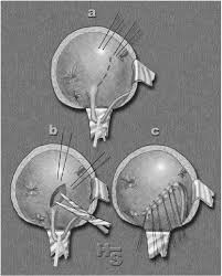 Opération de politano et de leadbetter. A To C Lich Gregoir Procedure Download Scientific Diagram