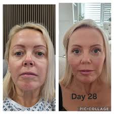 In Canada, what are the prices you are getting for deep plane facelift and  neck? I got a rough estimate of $40,000 for SMAS facelift and neck with a  surgeon in Calgary.